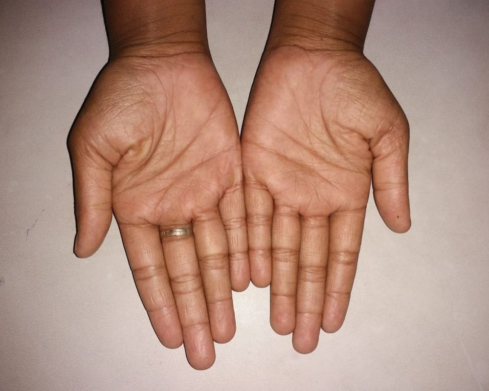 Sporisis After treatment