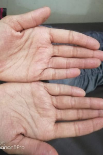 Sporisis After treatment