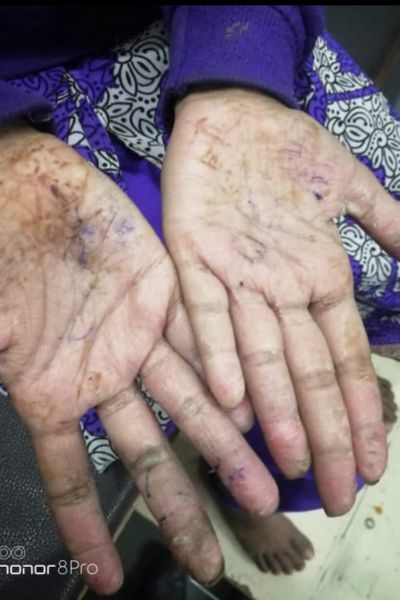 Sporisis Before Treatment