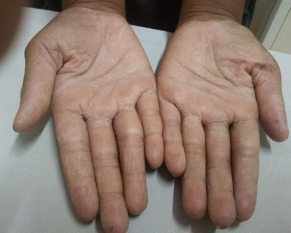 Sporisis before treatment