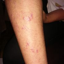 Eczema before treatment