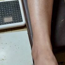 Eczema After treatment