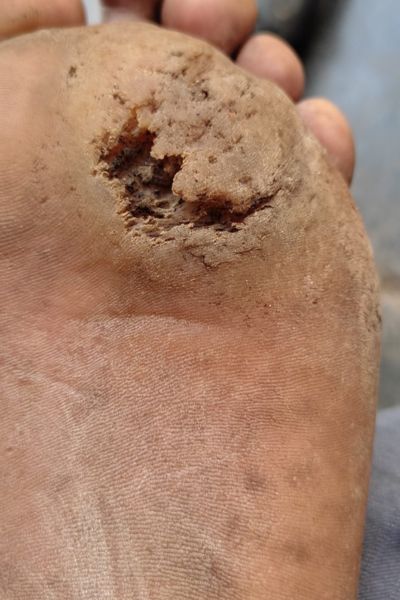Corns (कुरूप) Before treatment