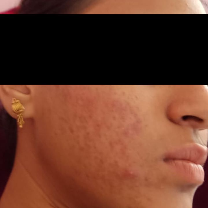 Acne before treatment