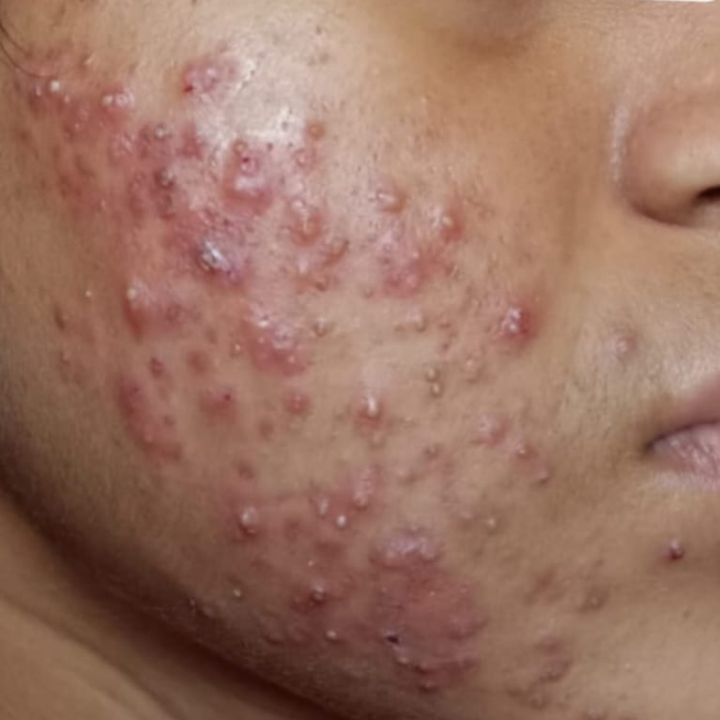 Acne before treatment