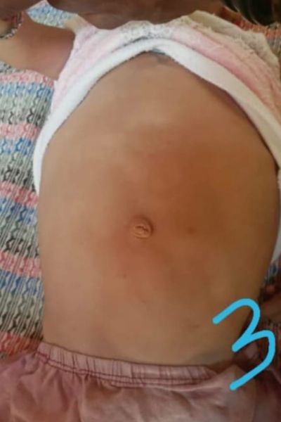 Glycogen storage disease After treatment