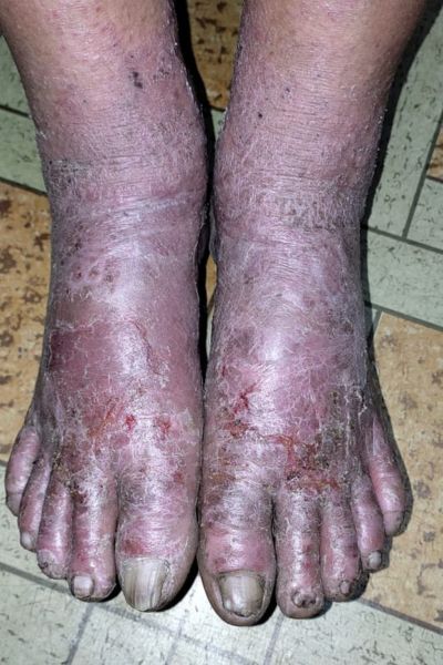 Sporisis Before Treatment