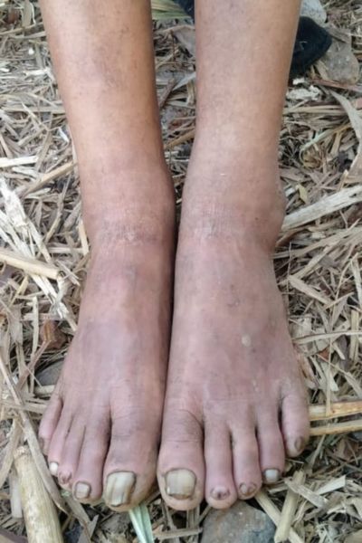 Sporisis After treatment