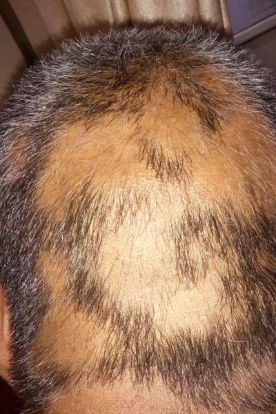 Alopecia ट्रीटमेंट Before treatment