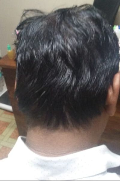 Alopecia ट्रीटमेंट After treatment