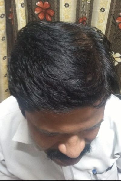 Alopecia ट्रीटमेंट After treatment