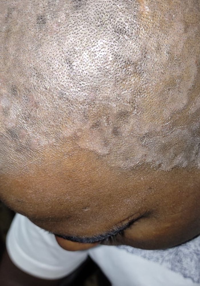 Eczema Before Treatment