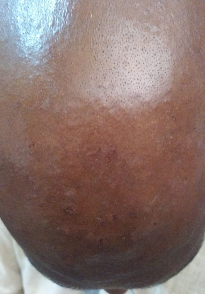 Eczema After Treatment