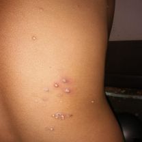 Warts (चामखीळ) treatment Before